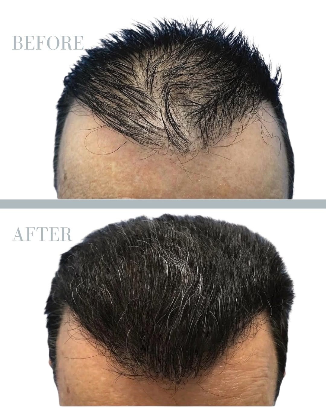 Före och efter hårtransplantation — patient i ålder 50+, resultat efter 12 mån.