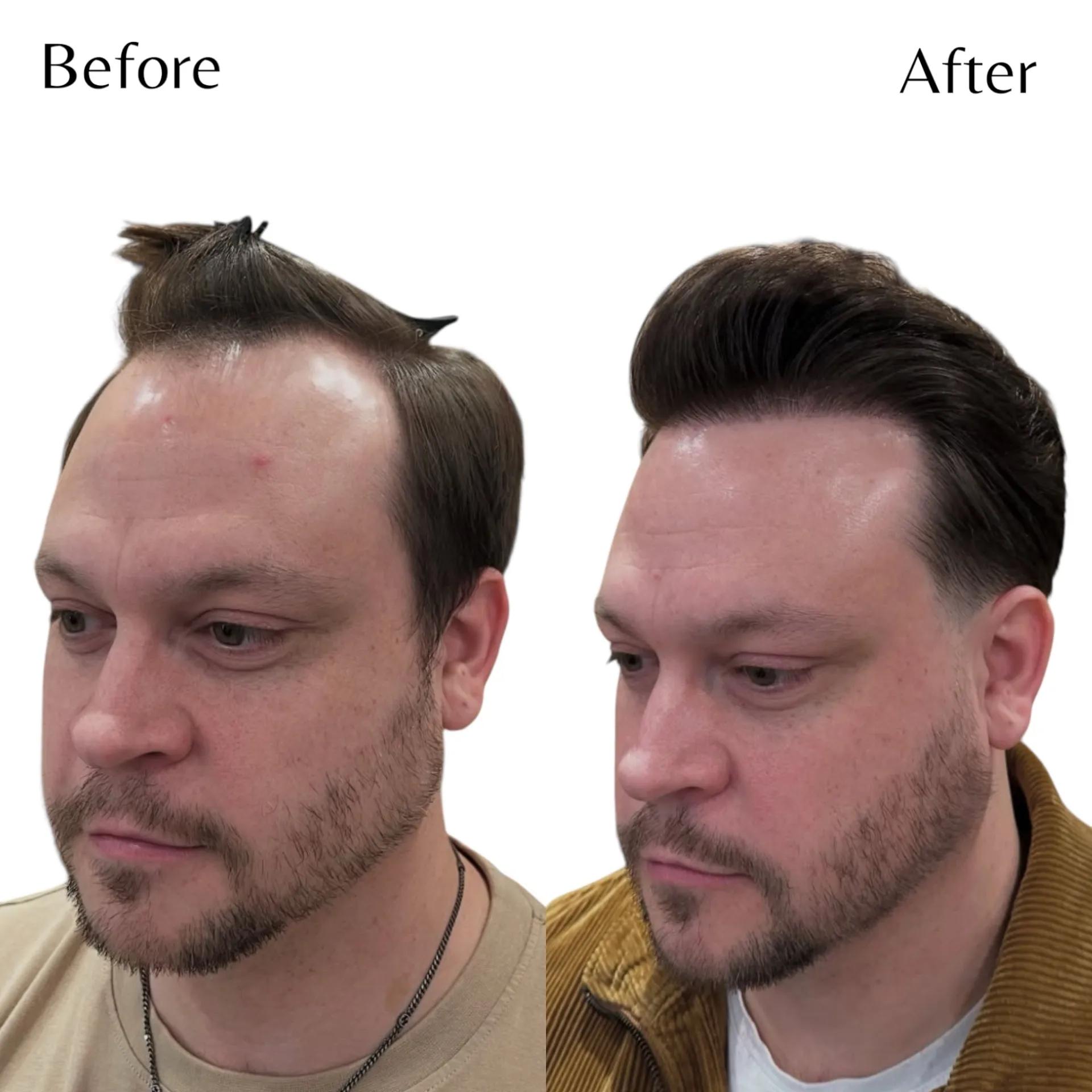 Före och efter hårtransplantation — patient i ålder 30–49, resultat efter 12 mån.