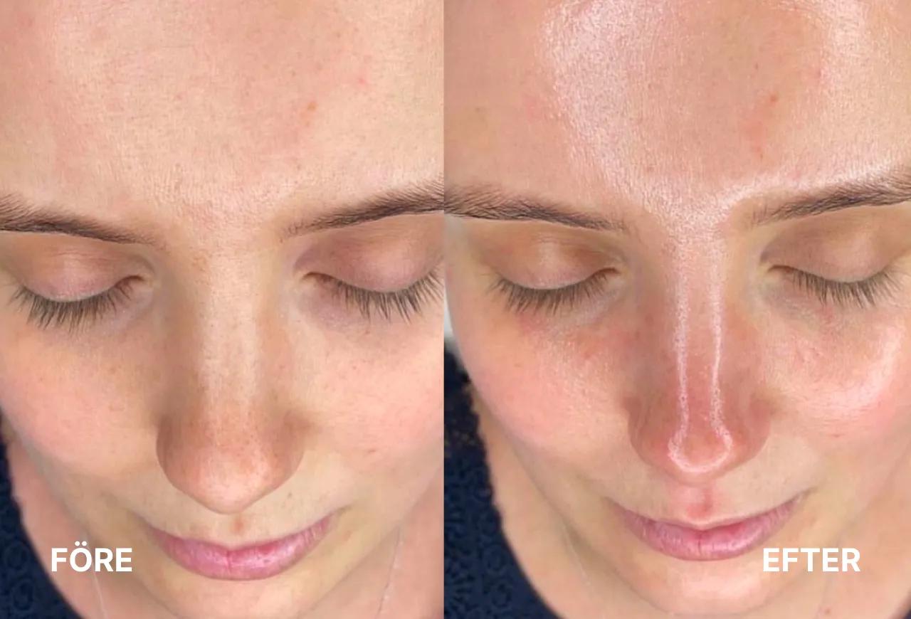 Dermapen vs kemisk peeling — vilken behandling passar din hud?