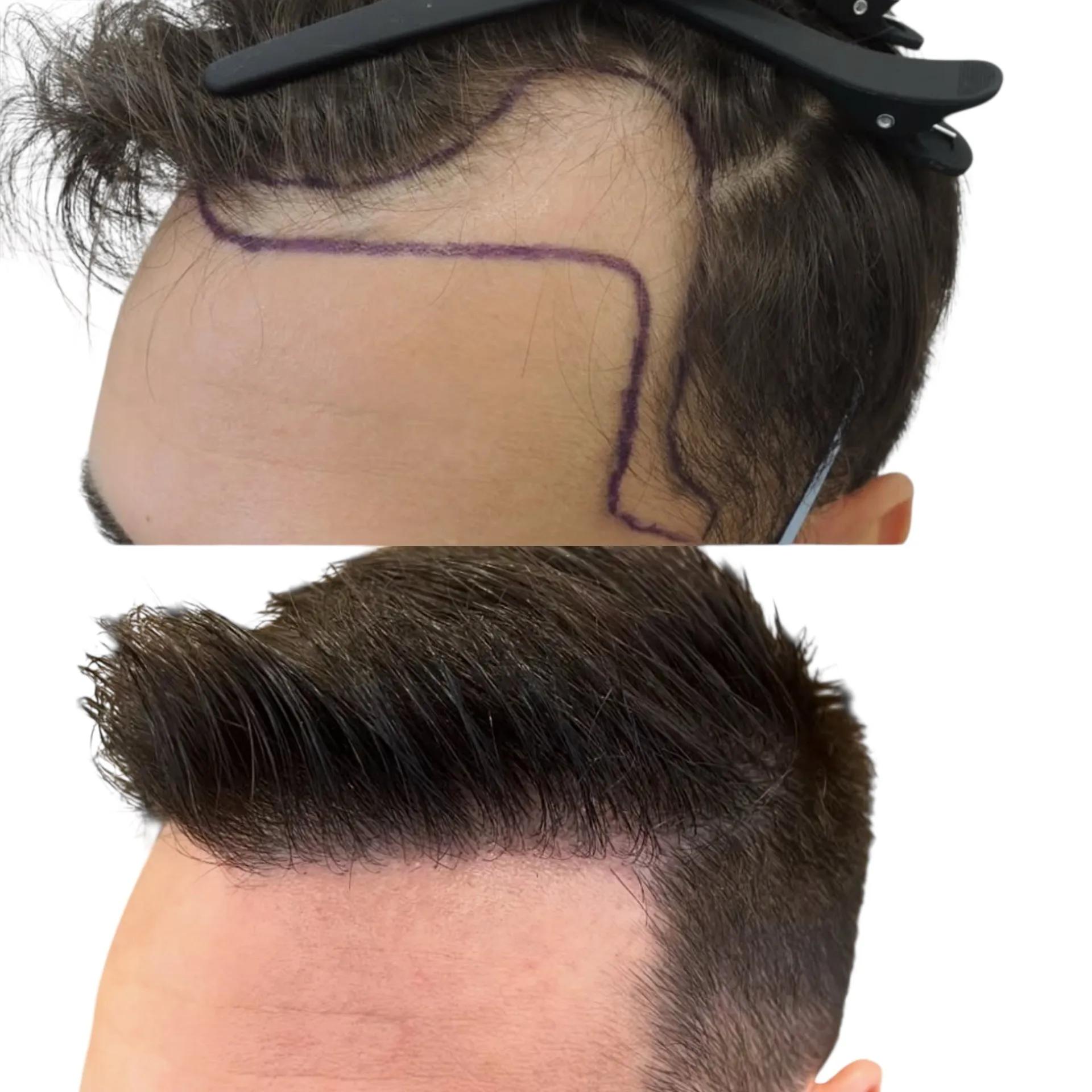 Före och efter hårtransplantation — patient i ålder 30–49, resultat efter 12 mån.