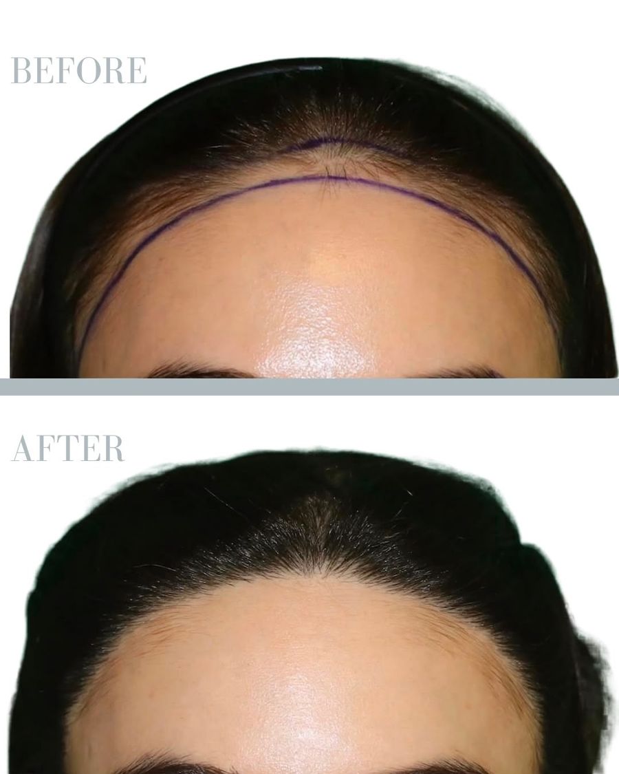 Före och efter hårtransplantation 1500 grafts