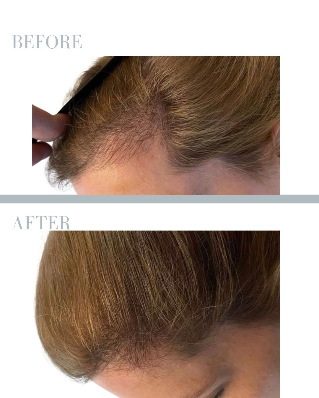 Before and after PRP.