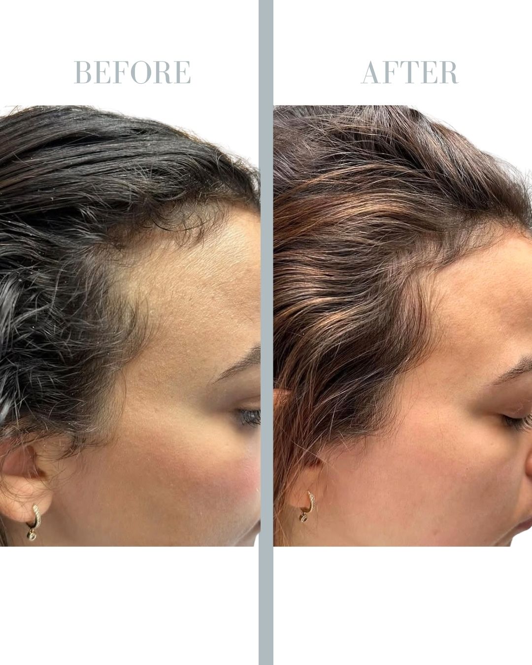 Before and after PRP.