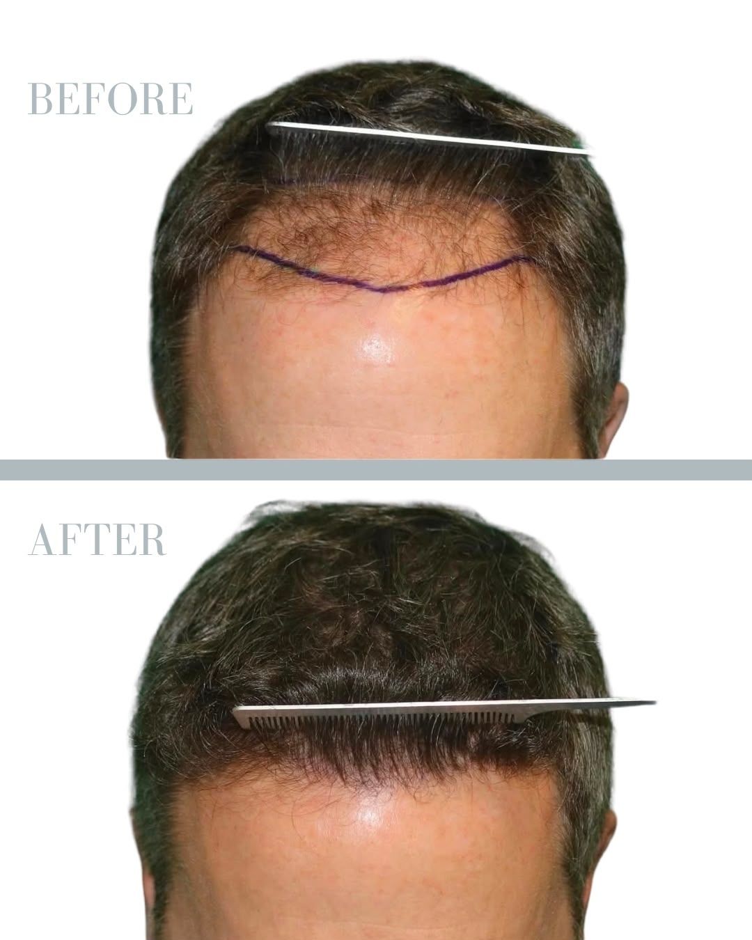 Före och efter hårtransplantation — patient i ålder 50+, resultat efter 12 mån.