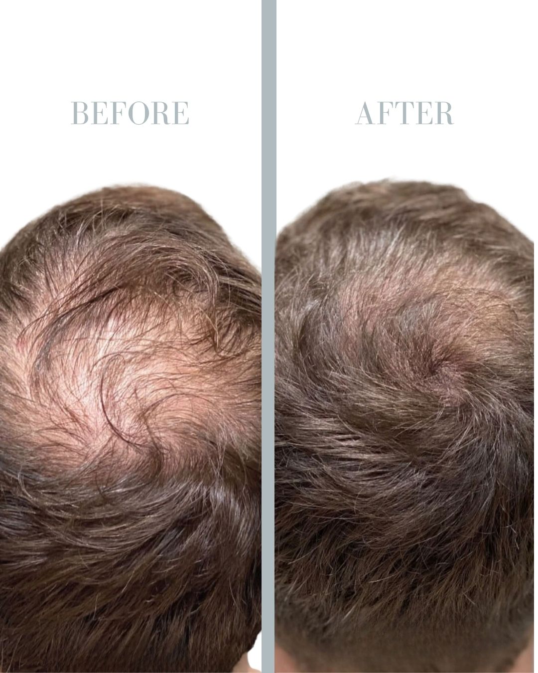 Before and after PRP.
