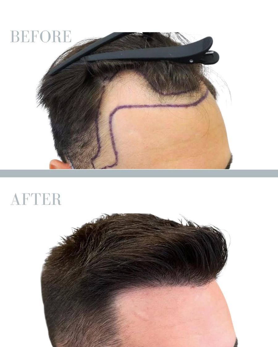 Före och efter - hårtransplantation 2500 grafts