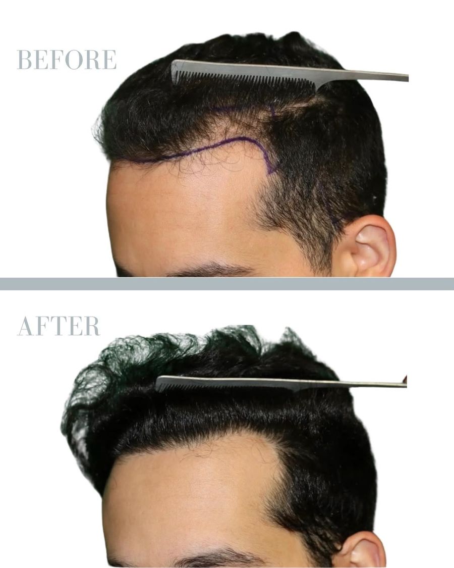 Före och efter — hårtransplantation, 1500 grafts