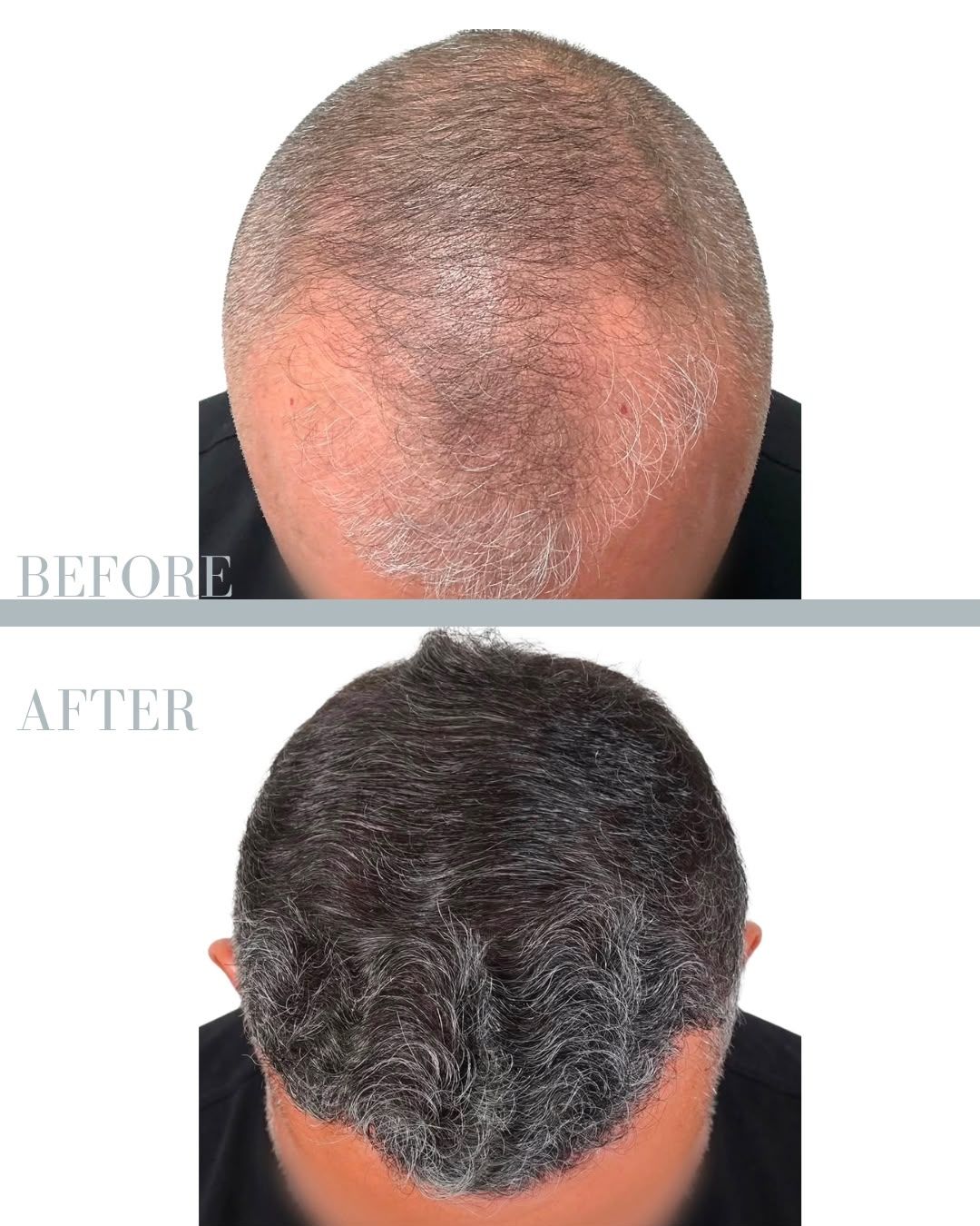 Före och efter hårtransplantation — patient i ålder 50+, resultat efter 12 mån.