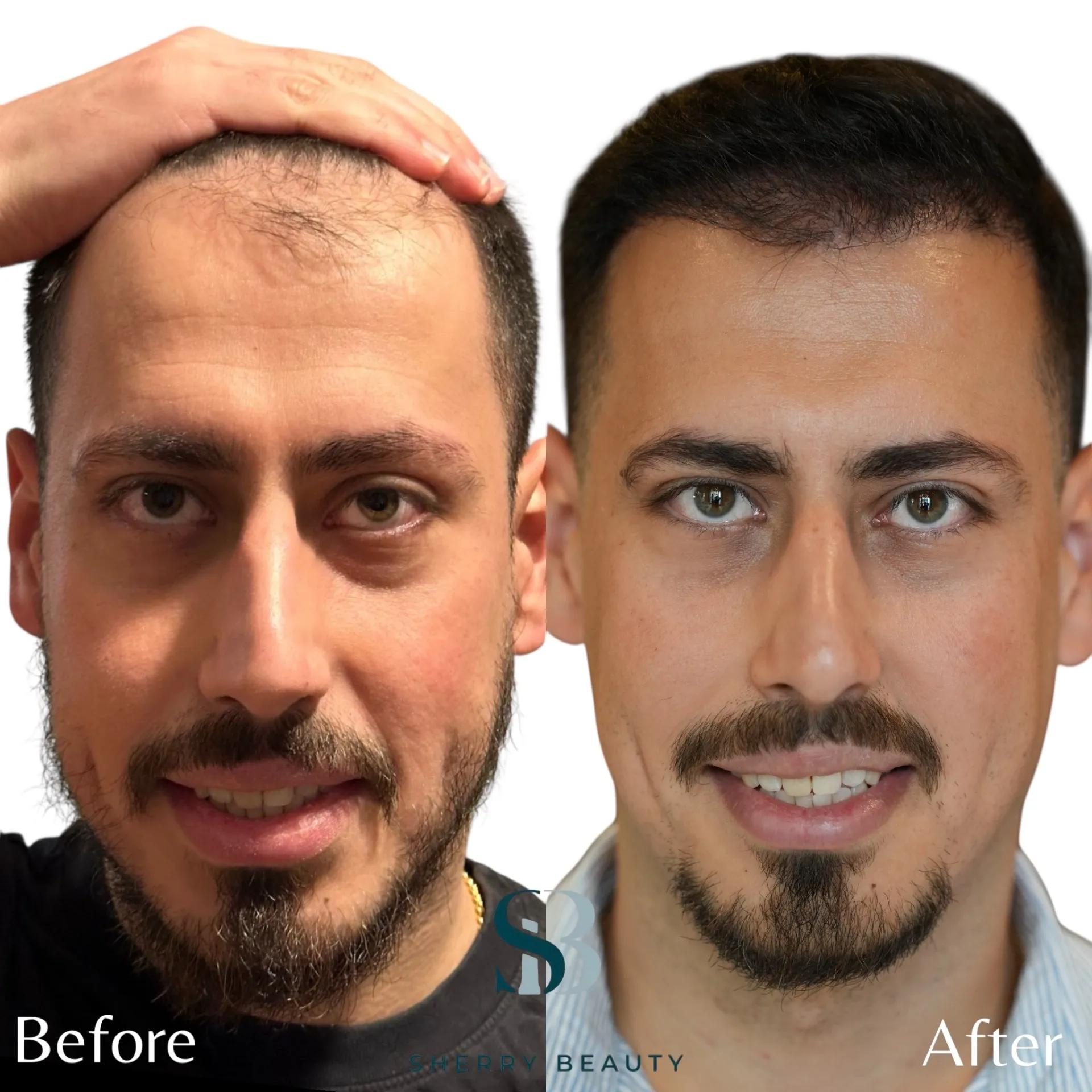 Före och efter hårtransplantation — patient i ålder 18–29, resultat efter 12 mån.