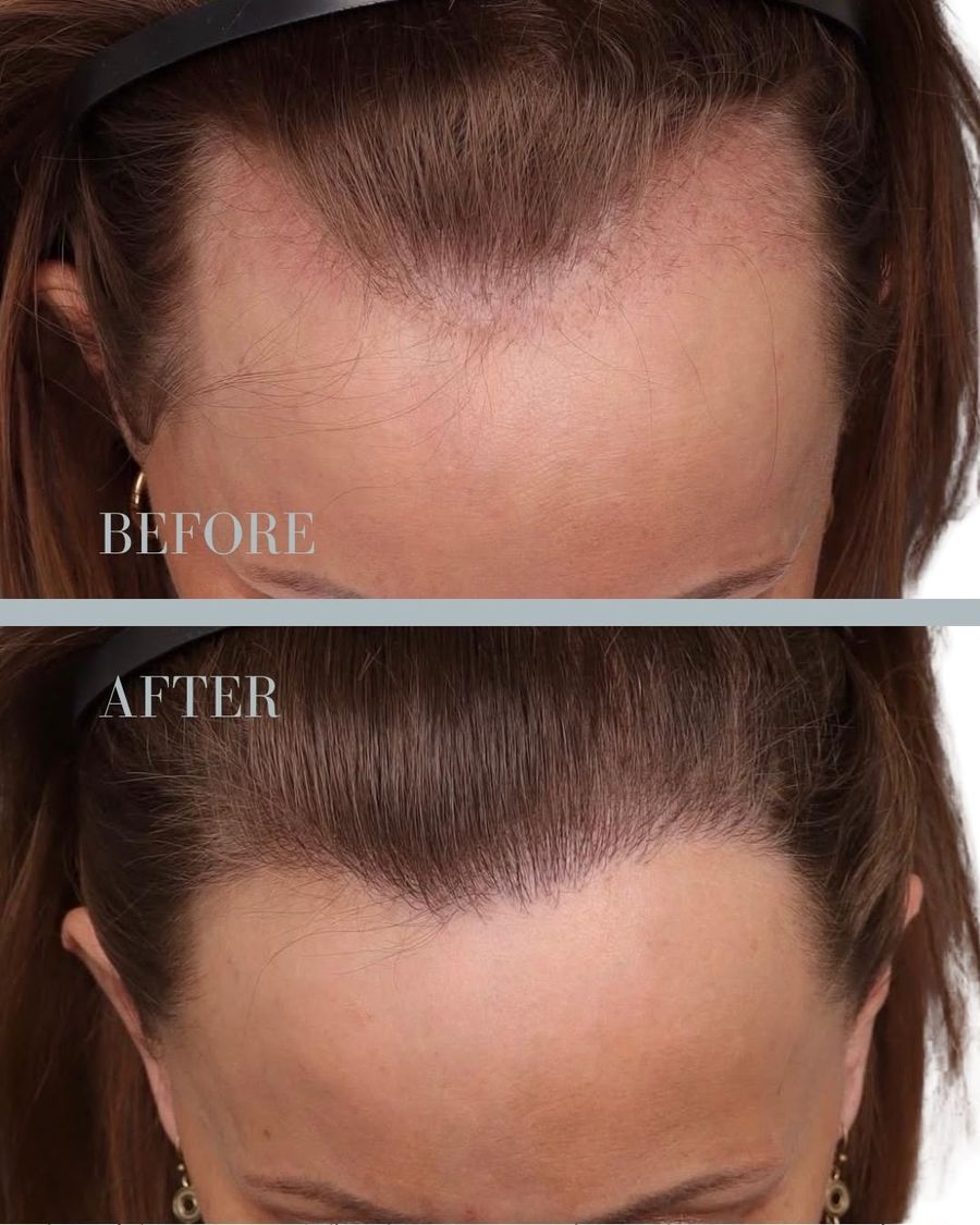 före efter hårtransplantation 2500 grafts