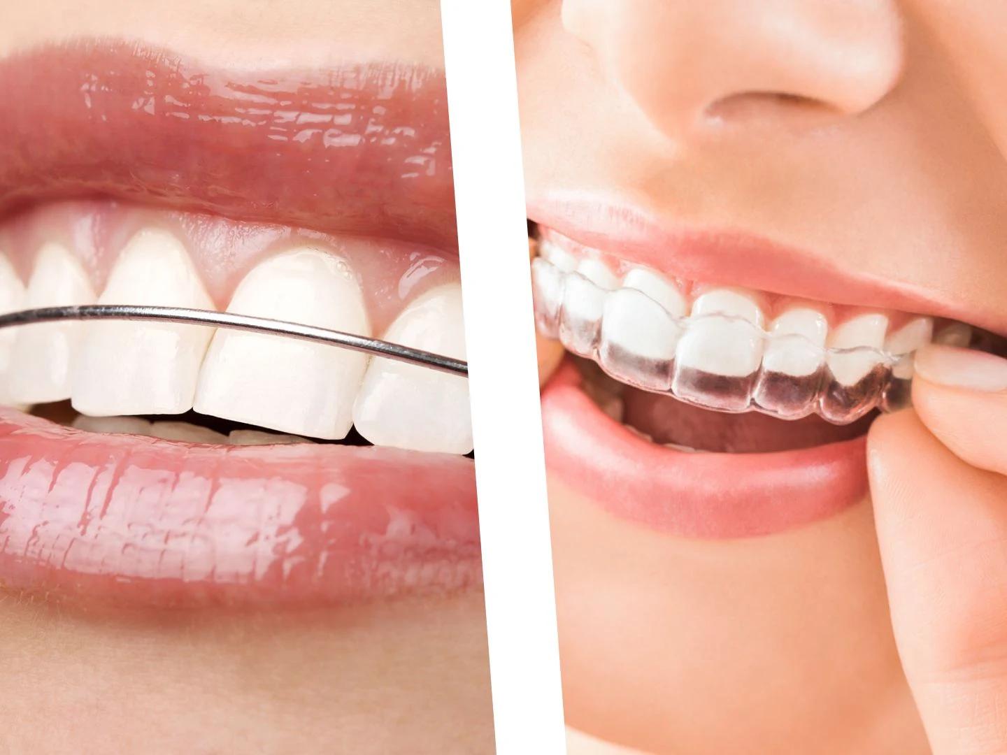 Orthodontic treatment