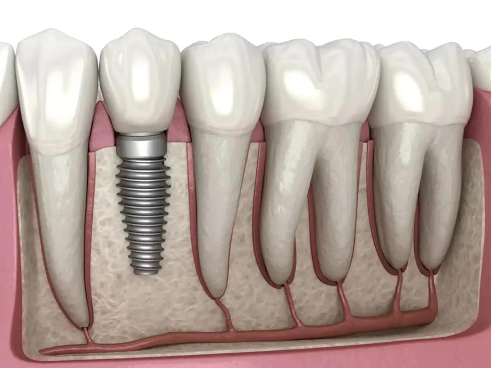 Dental implants image representing top European destinations for dental implants abroad 2021