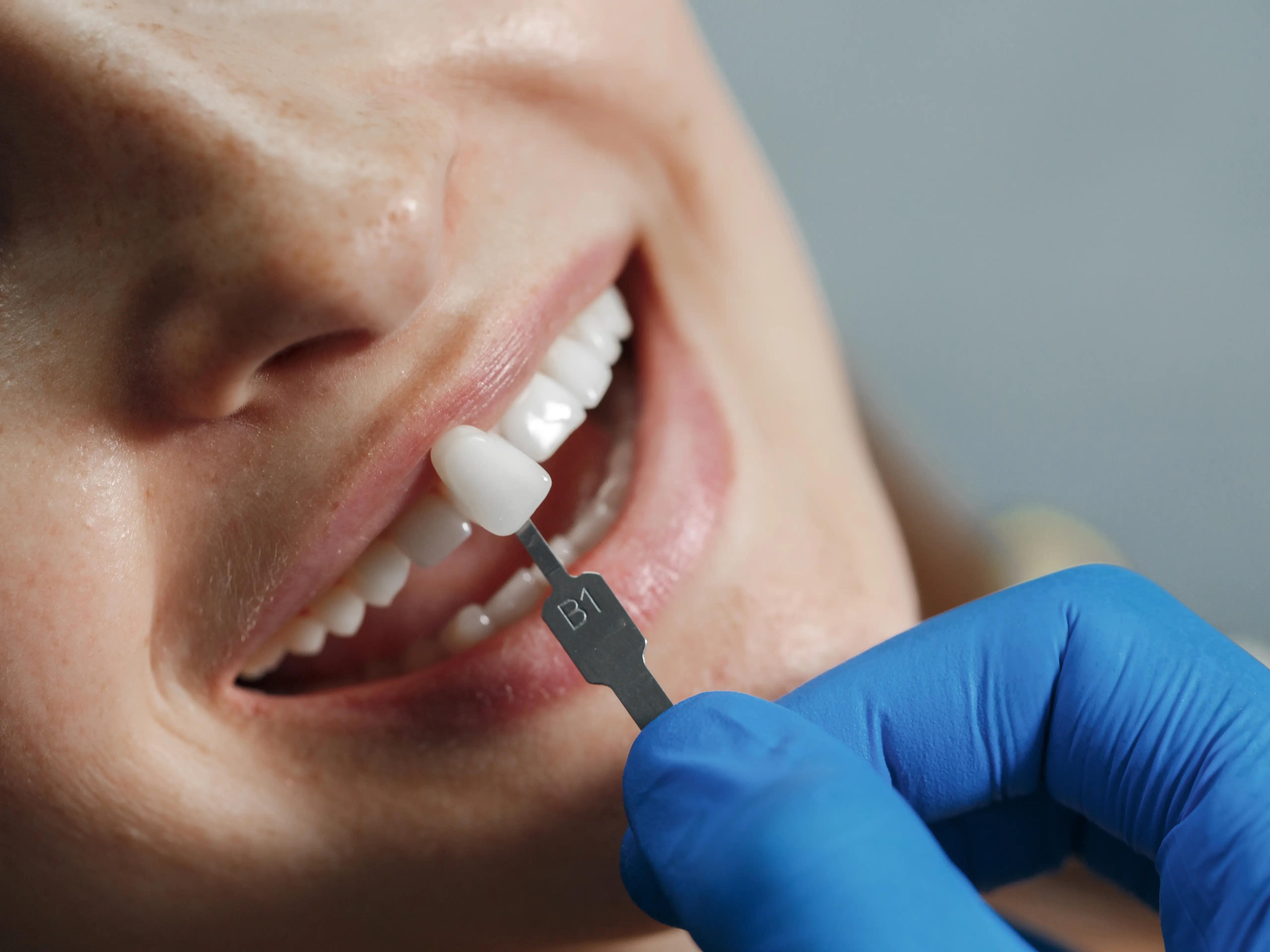 A girl getting dental veneers