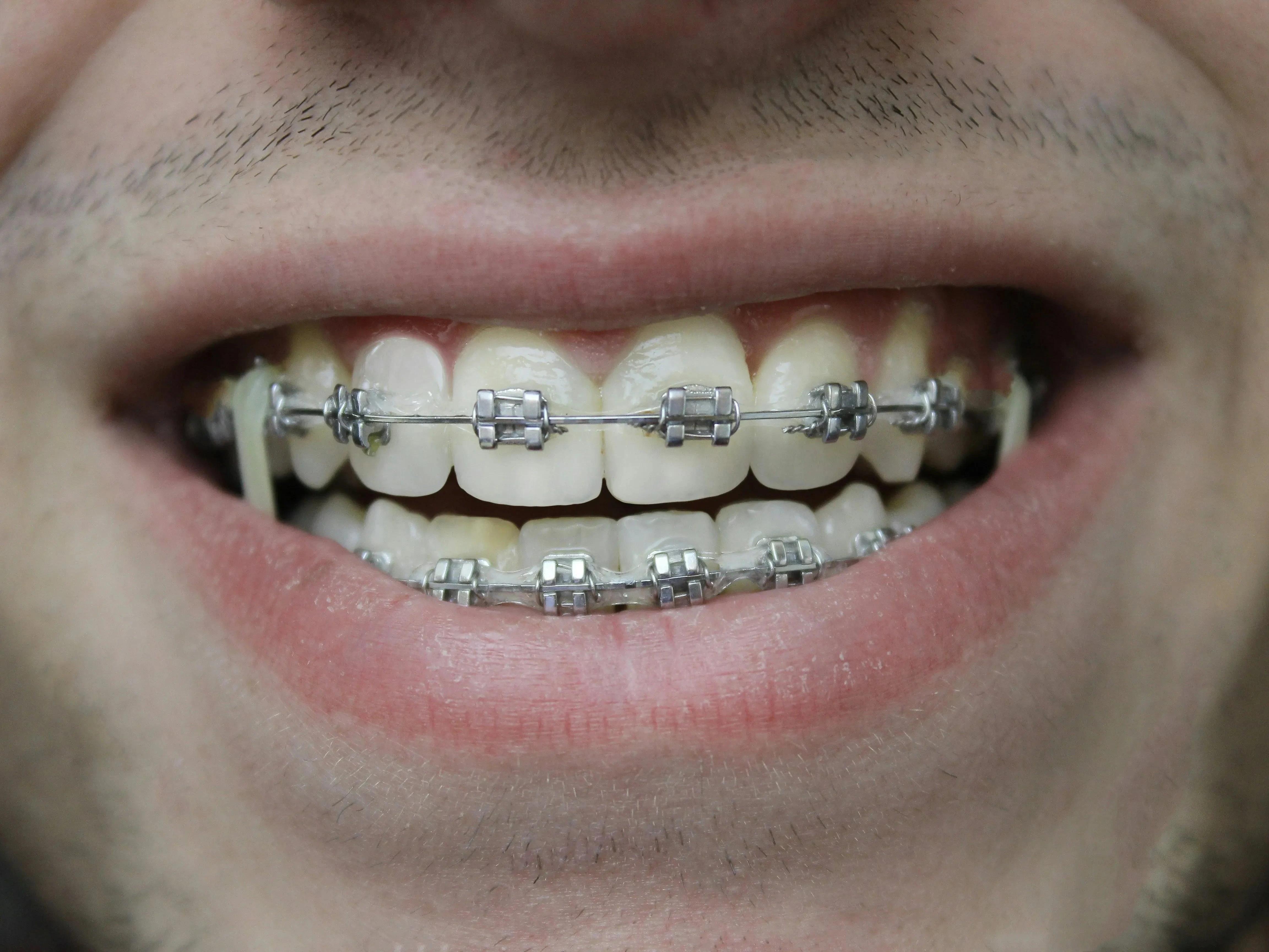 A man with braces