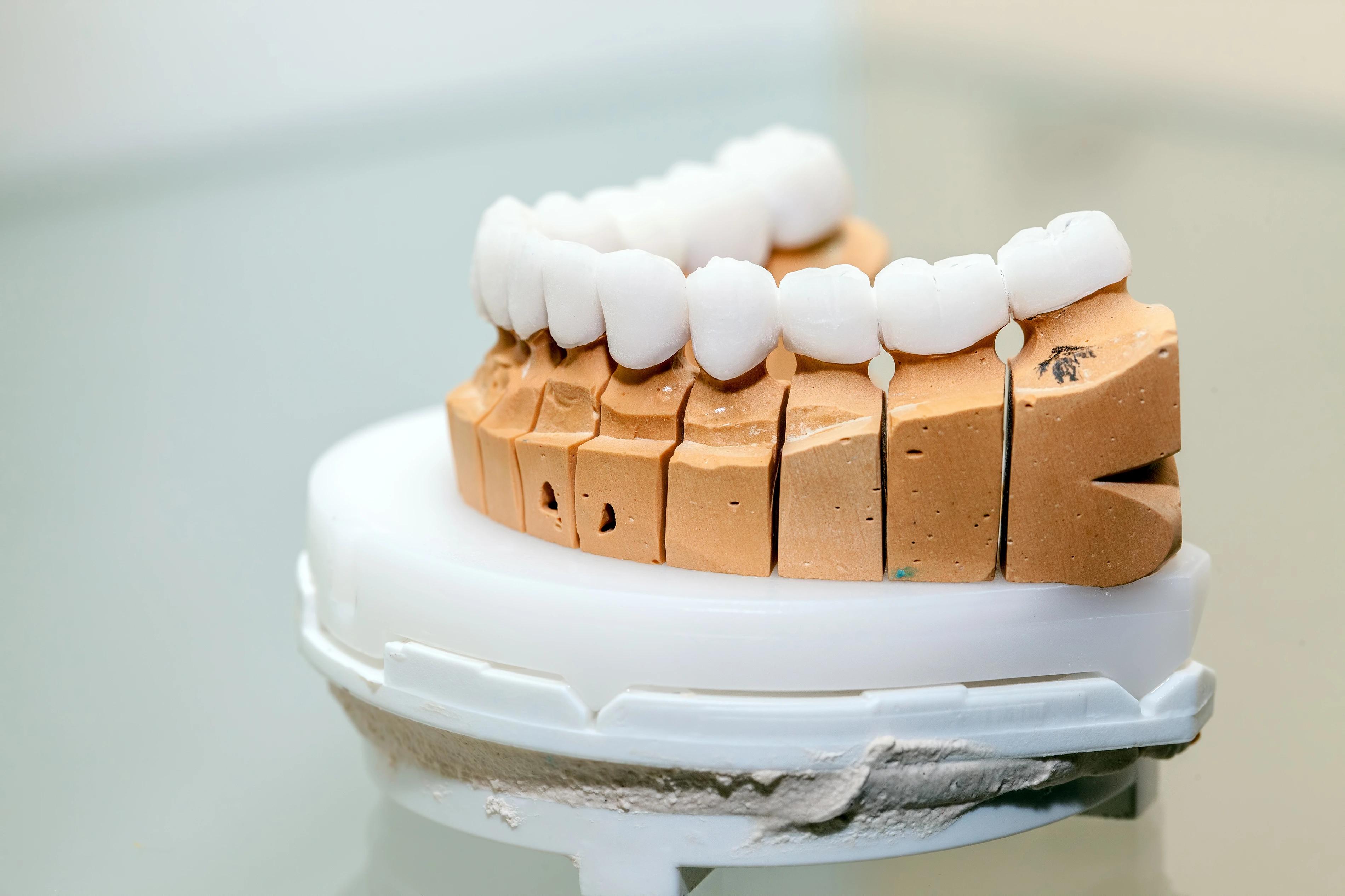 Image showing dental veneers-dental veneers and crowns comparison 