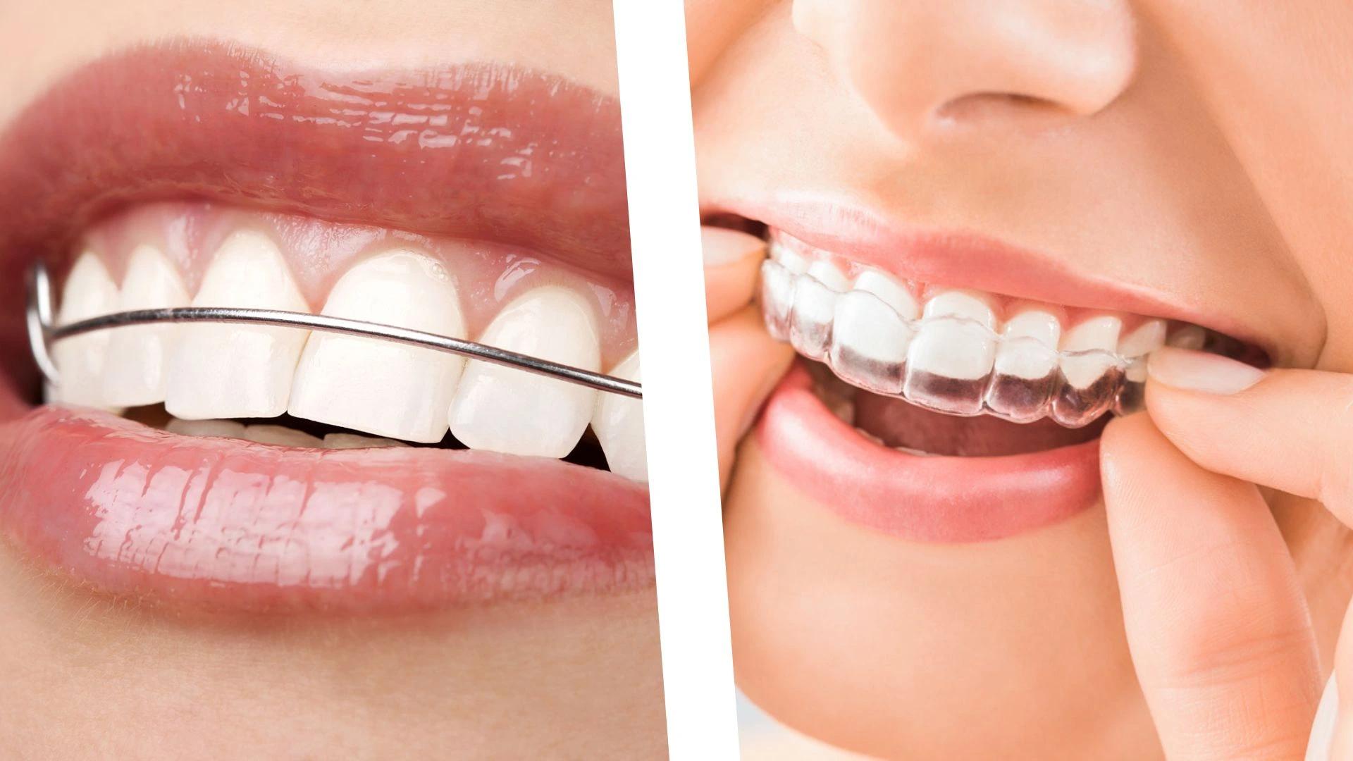 Orthodontic treatment