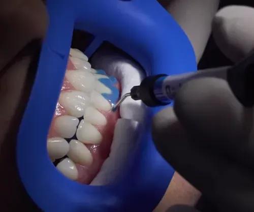 Teeth Whitening Offer