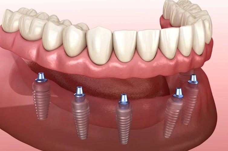 All-on-6 Full Arch Rehabilitation