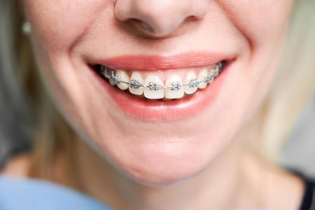 Girl with braces