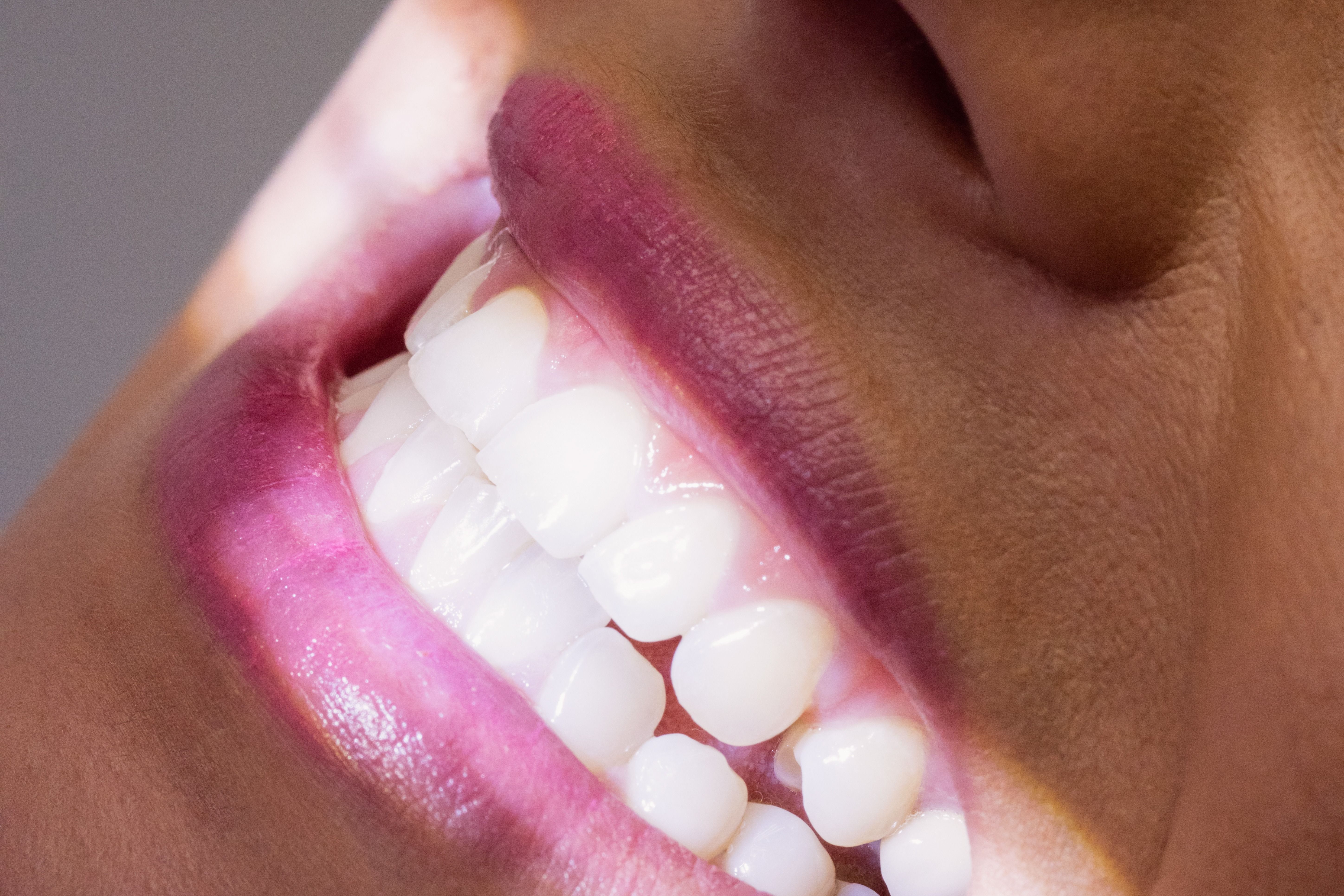 receiving a teeth whitening