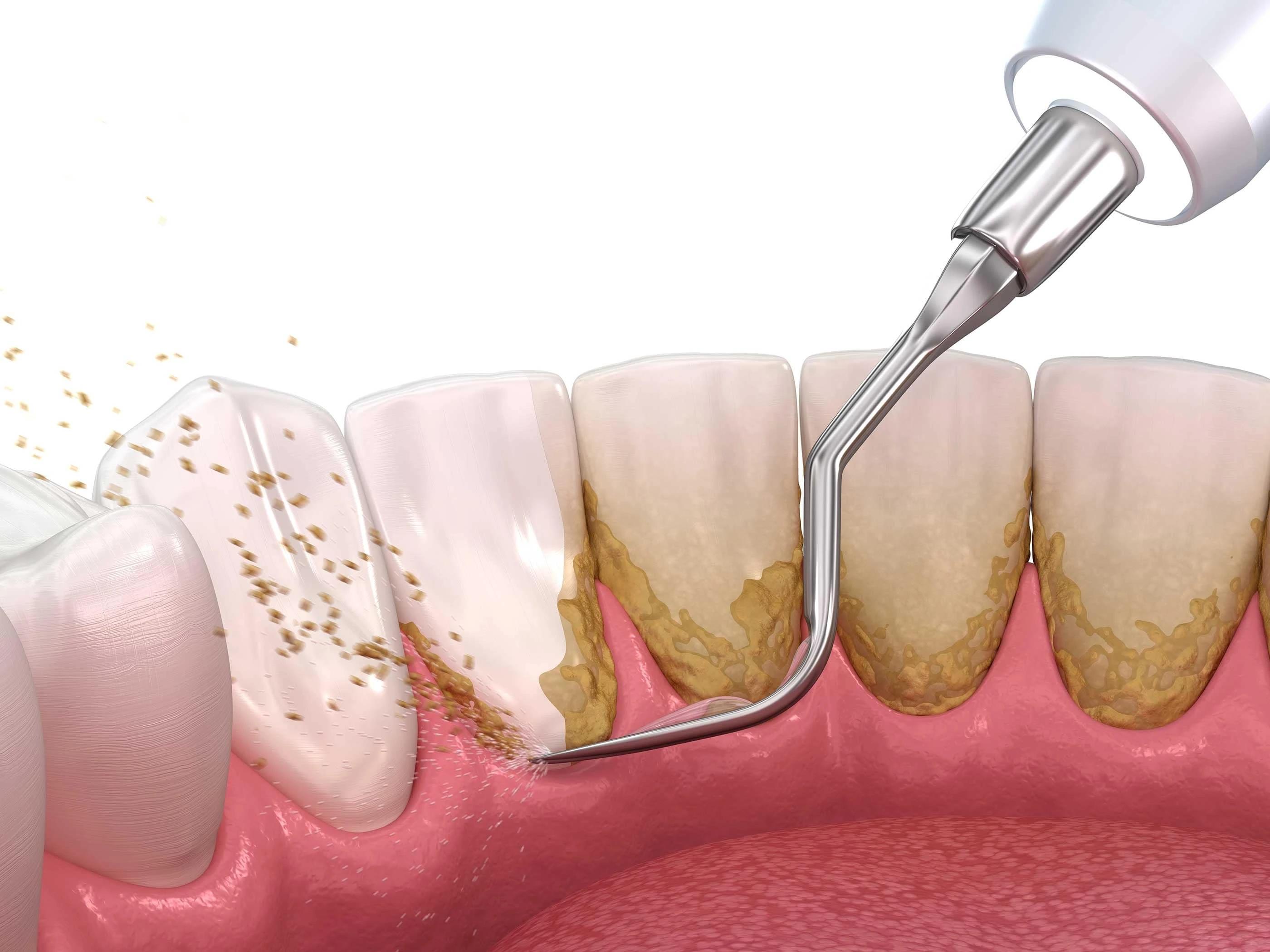 A img of removing tartar and promoting dental hygiene for a healthier smile