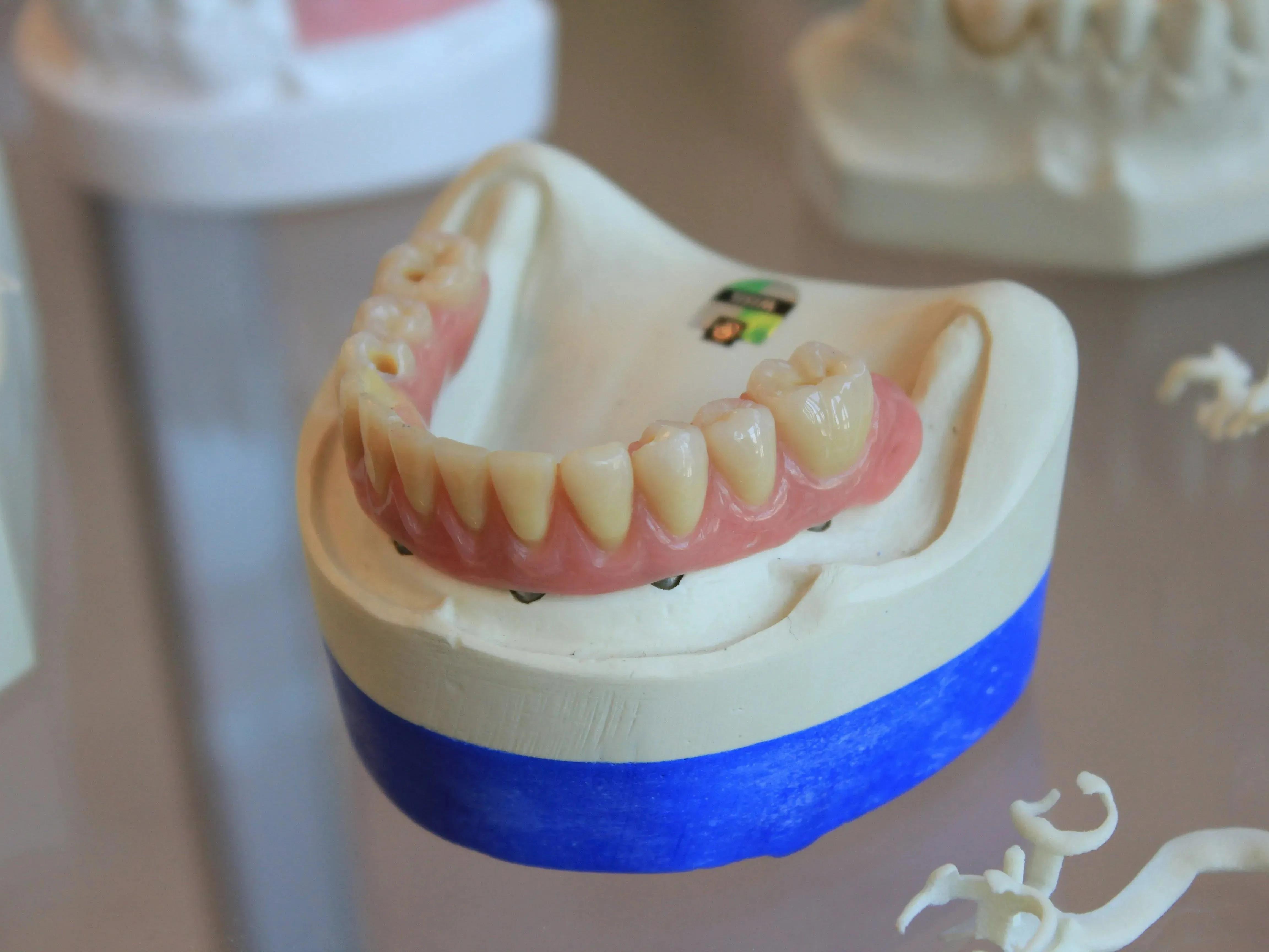 A sample of dental bridges