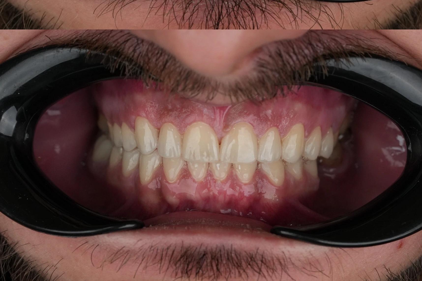 Composite Bonding Package