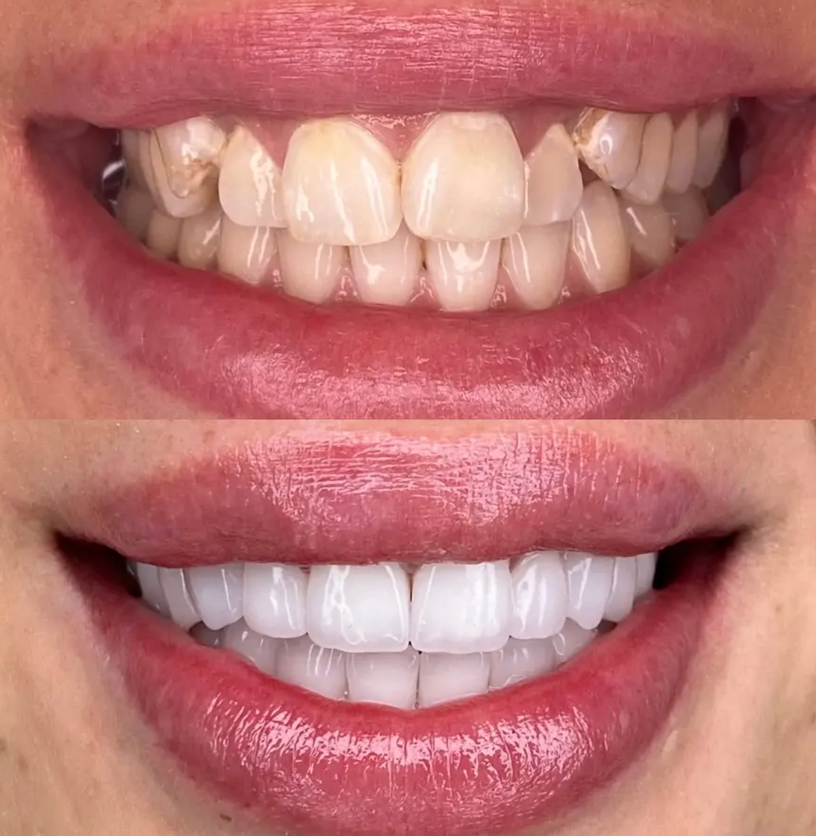 Smiling girl showcasing Emax Veneers