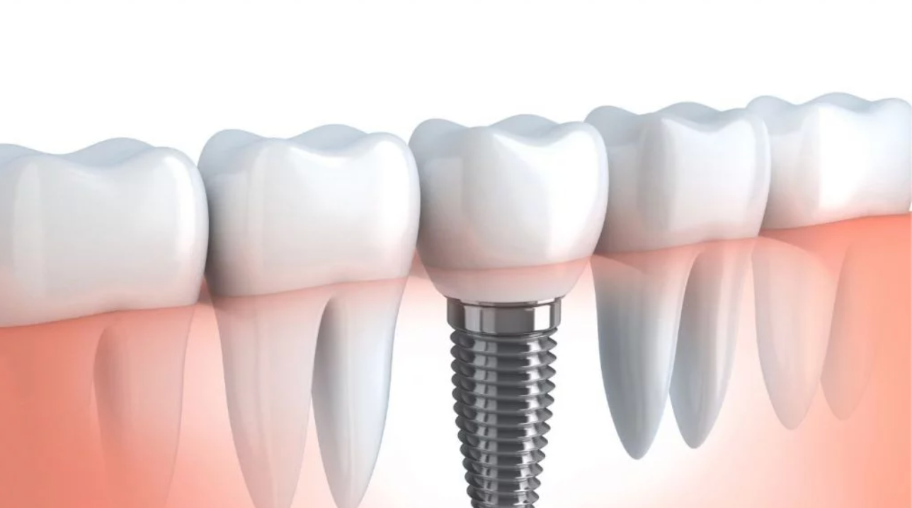 Dental implants image representing top European destinations for dental implants abroad 2021