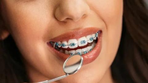 Metallic Braces in Saranda