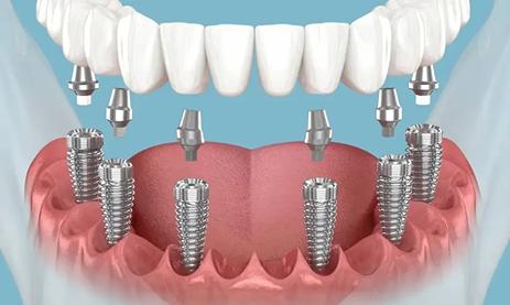 20% Off Implants All on 6