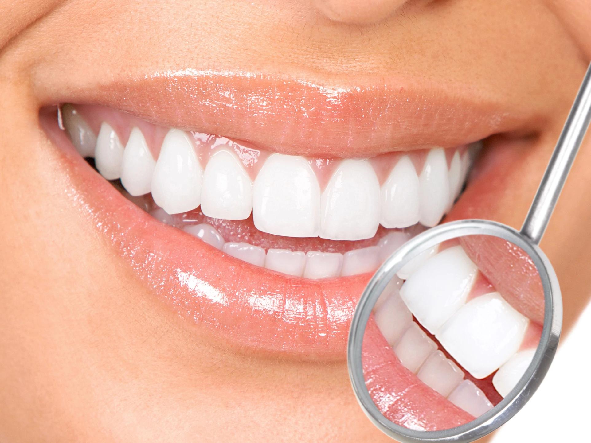 Composite Bonding Smile