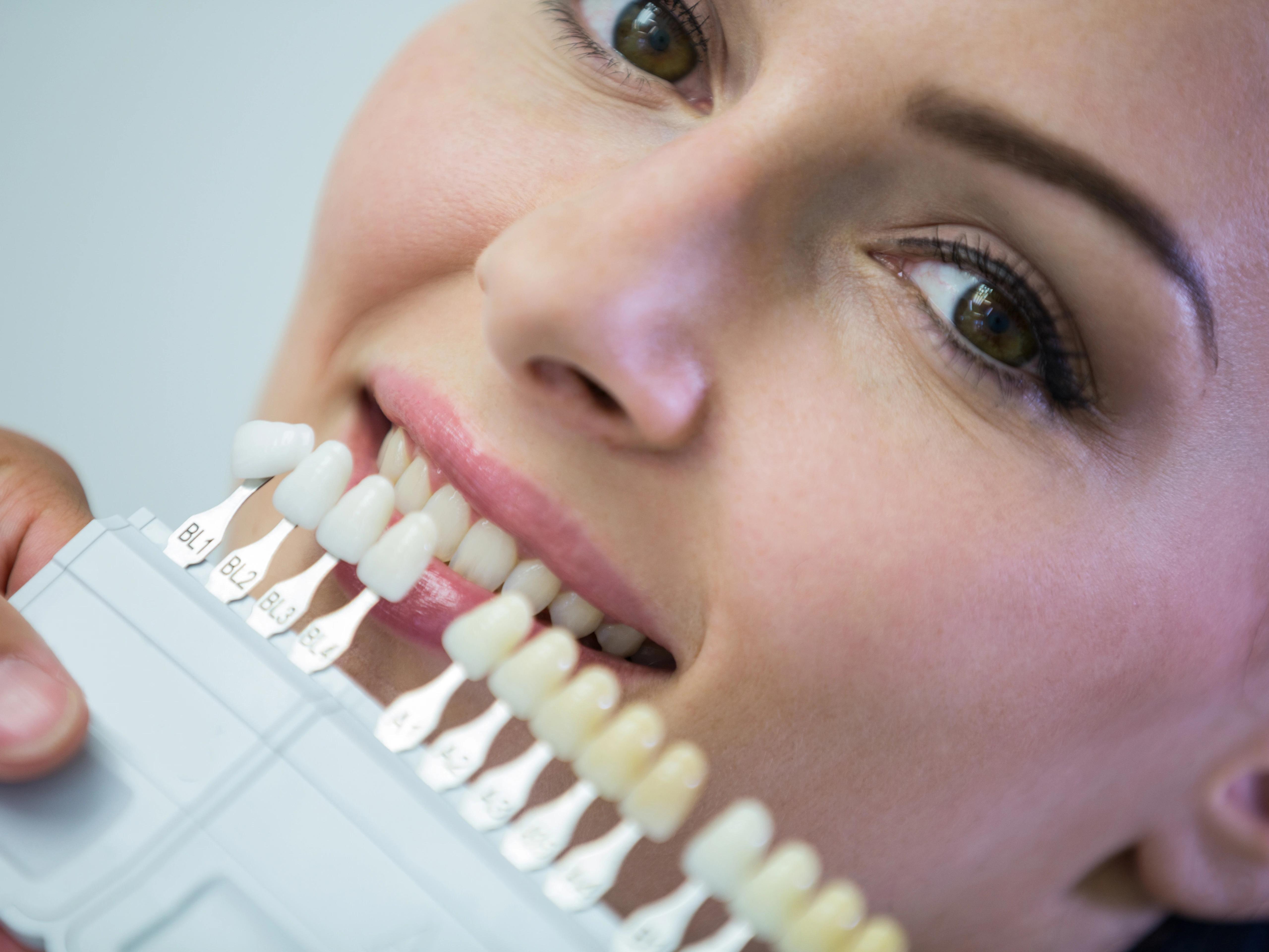 dental-veneers