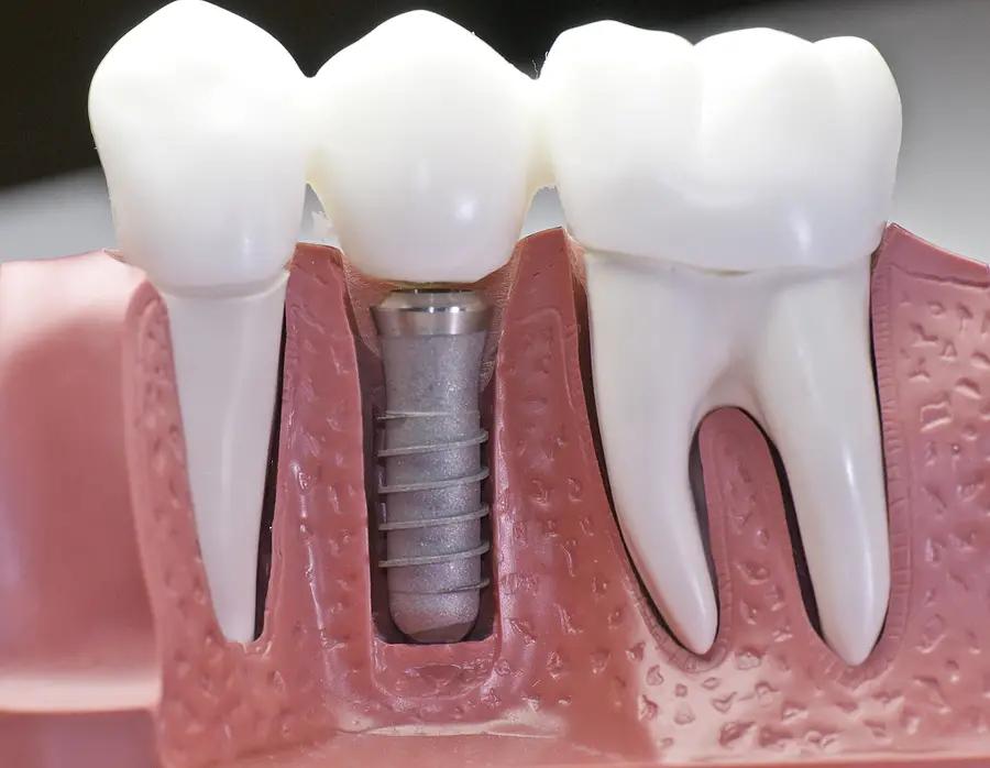 Dental implants cost explanation in the UK - image of implants