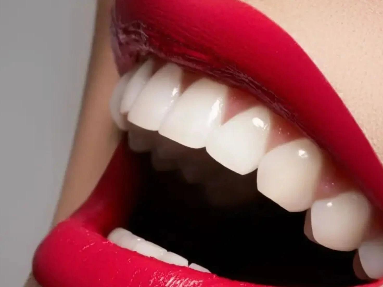 Smiling girl showcasing Emax Veneers