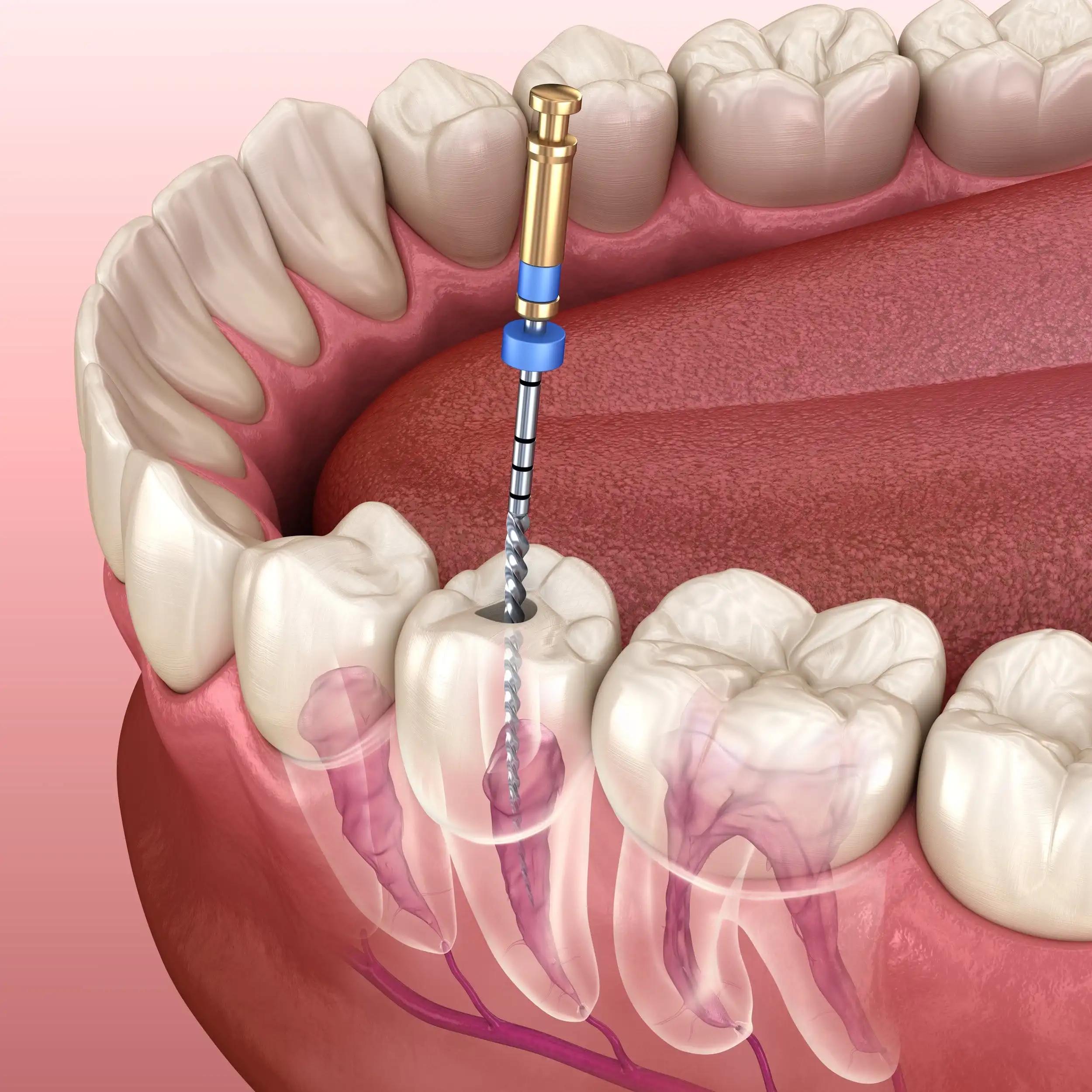 Root canals of the tooth being treated