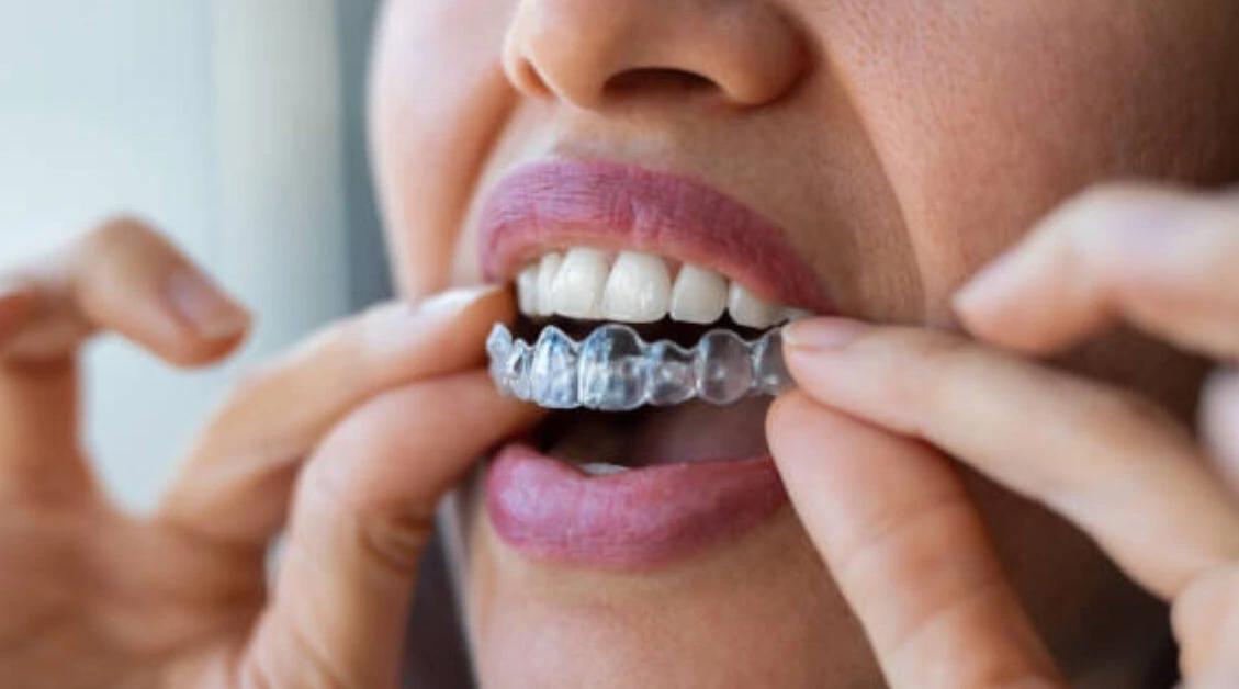  The benefits of Invisalign