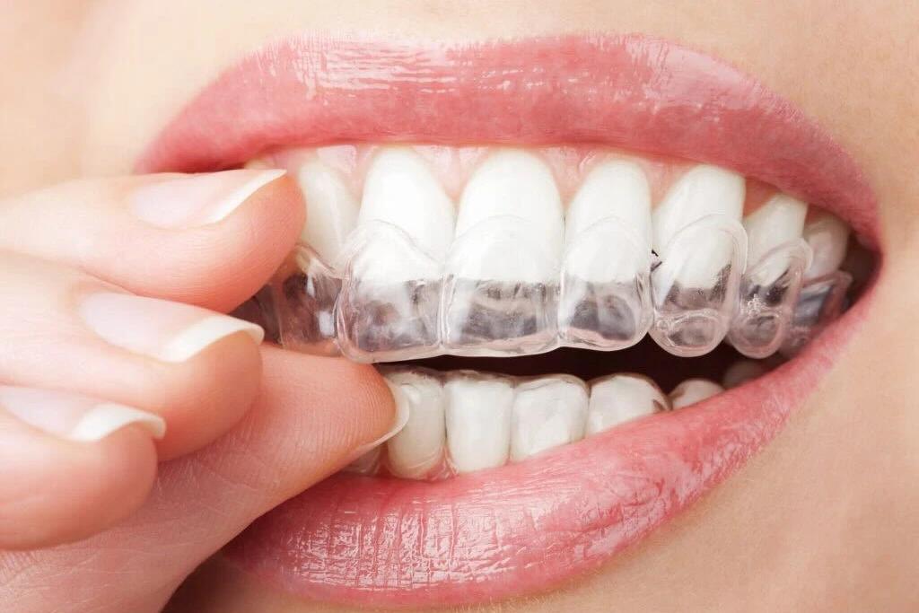 aligners