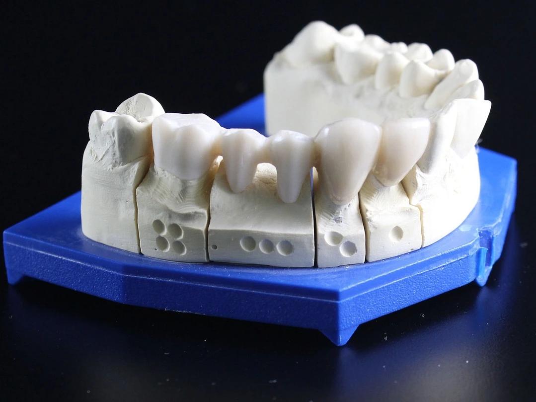 Dental bridge displayed on a gum model for demonstration purposes.