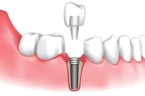 dental implants