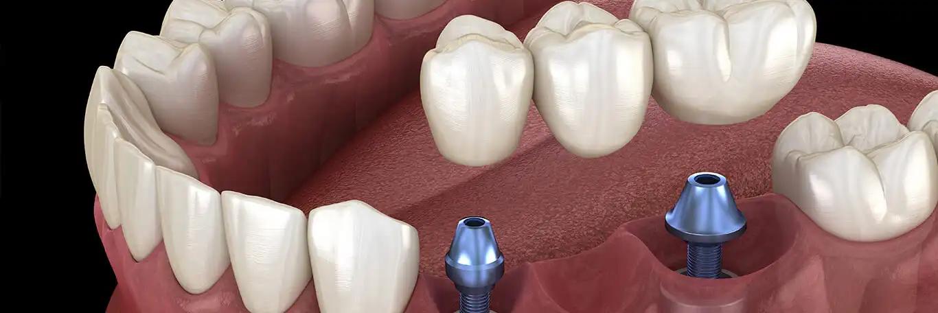 Dental Implants 