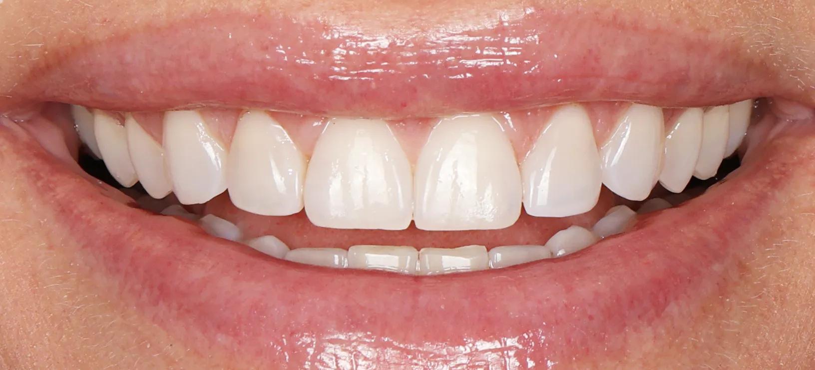 Same day Composite Bonding