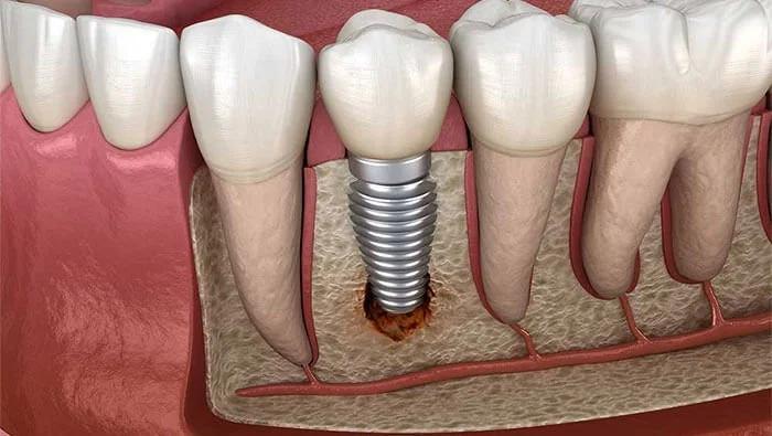 Bone deficiency requiring dental bone graft treatment