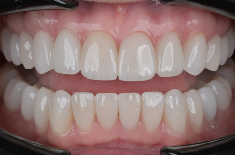 Composite Bonding in Durrës