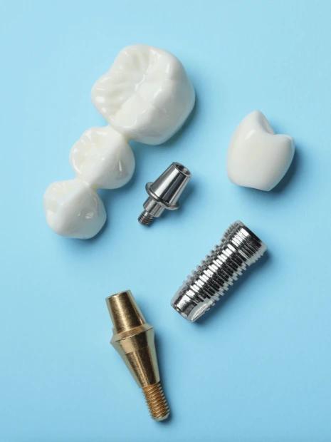 Dental implants procedure comparison Albania vs other countries