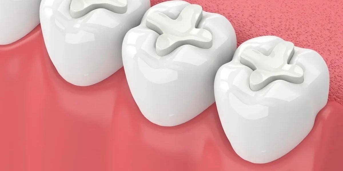 Teeth with white fillings