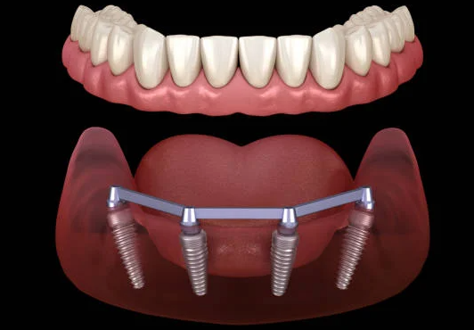 All-on-6 full treatment package