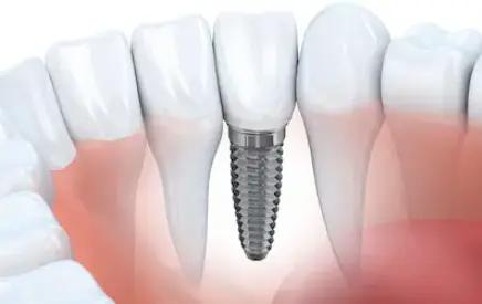 Dental implants cost explanation in the UK - image of implants