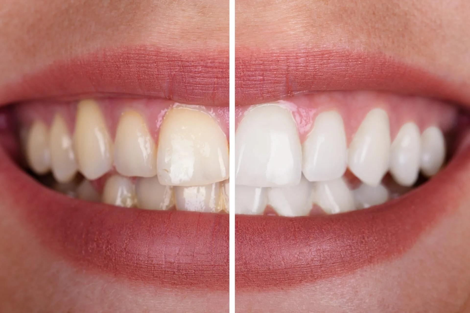 Teeth whitening before and after