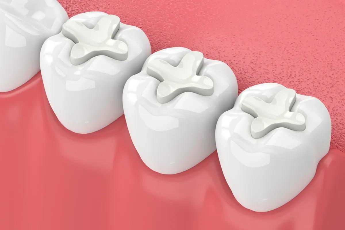 Teeth with white fillings